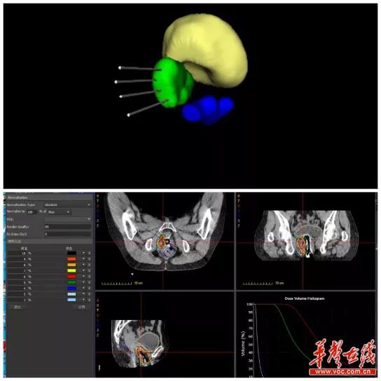 让放射源巧入人体 3D打印技术助力妇科肿瘤精准放疗