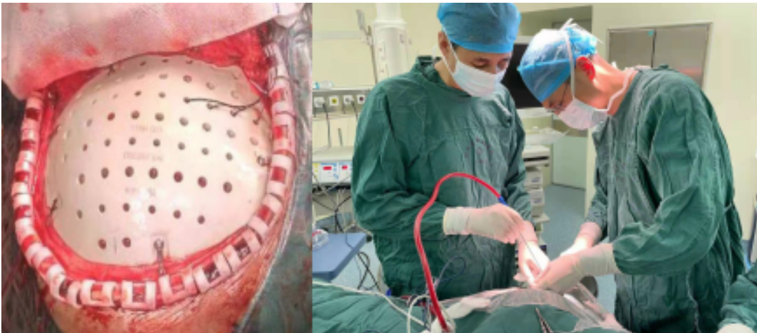 PEEK新材料3D打印颅骨修补术在陕西省中医院顺利完成