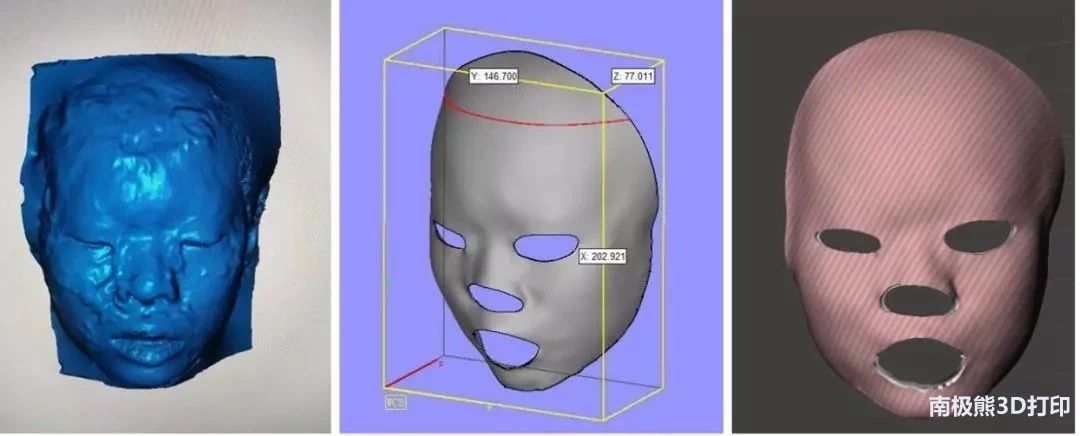 广东省工伤康复医院开展3D打印技术助力自闭症烧伤少女康复