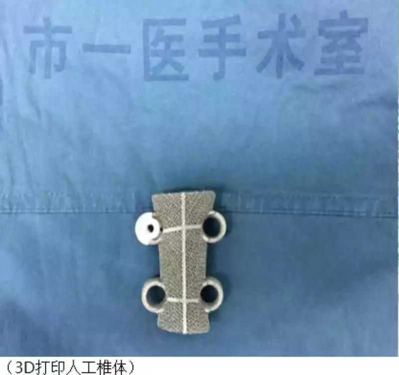 武汉市第一医院：3D打印人工椎体让腰椎“再生” 个体化定制助力脊柱肿瘤精准医疗