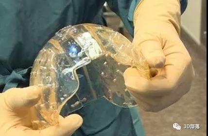 个性化医疗风起云涌，3D打印火热医疗应用大盘点！