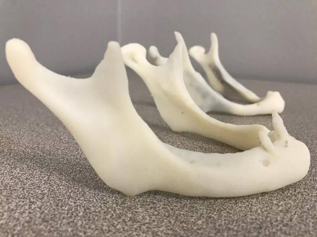外科医生如何利用3D打印技术进行下颌手术呢？