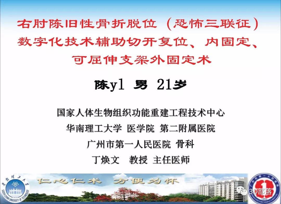 3D数字化技术辅助肘关节恐怖三联征精准修复