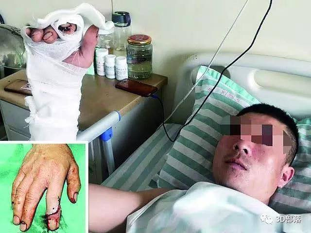 沧州中西医结合医院：男子手指被砸断无法再植，“3D打印”为他再造“完美”手指