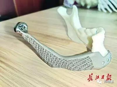 创新 ｜ 华中地区首例3D打印钛合金 “下颌骨”移植成功