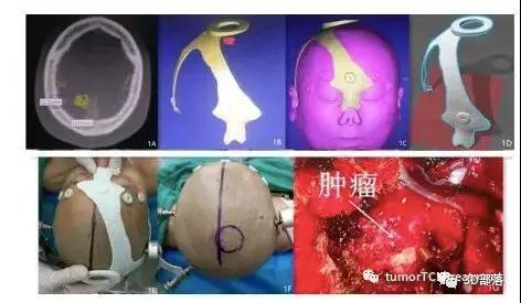 3D打印技术在脑膜瘤术前定位中的初步应用