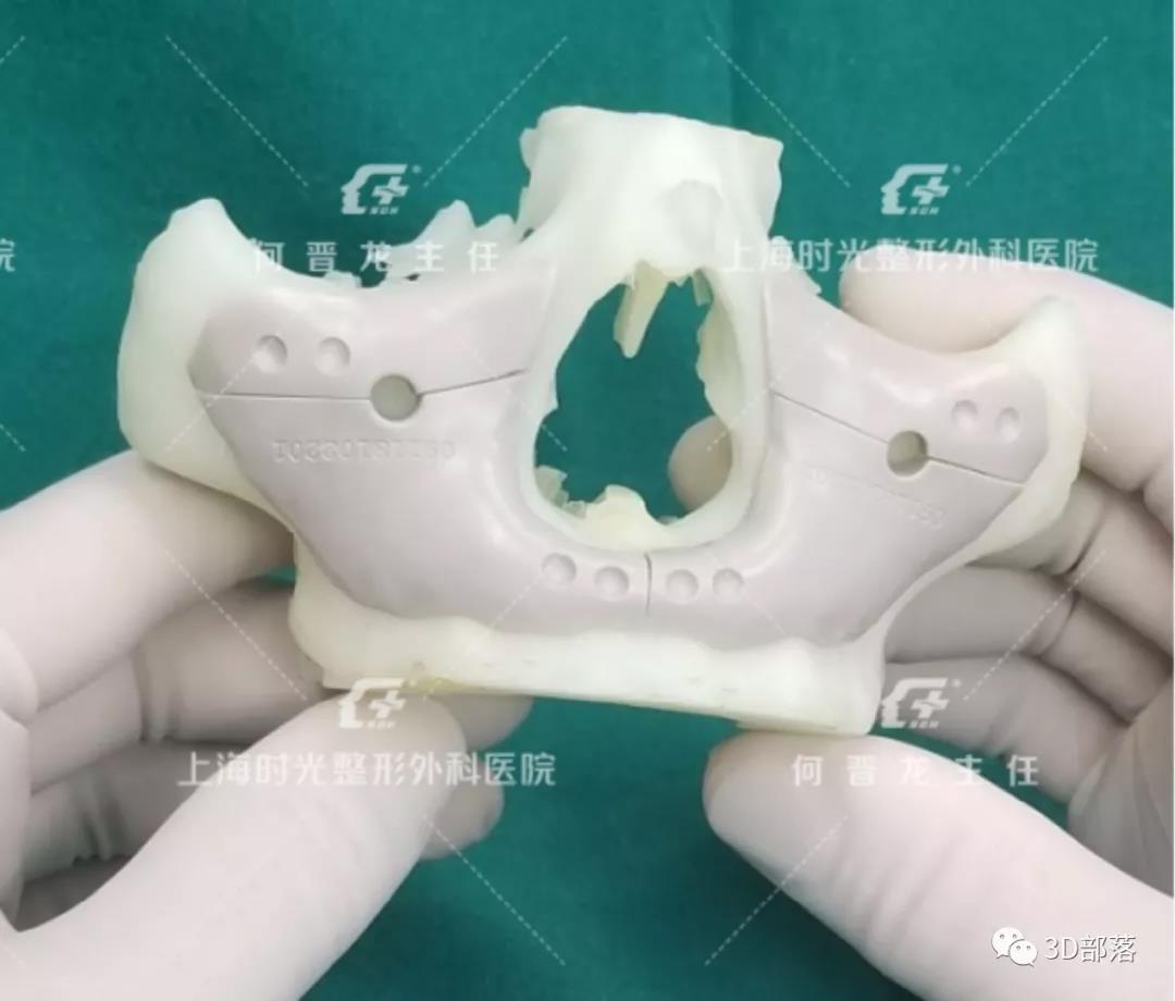 如果你早几年知道这技术，颌面整形真的没啥好怕的