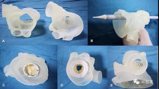 西京医院实施亚洲首例3D打印指导下经导管二尖瓣瓣中瓣置换术