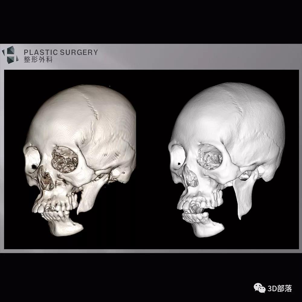 H整形医院运用3D打印技术，助力下颌骨骨折手术