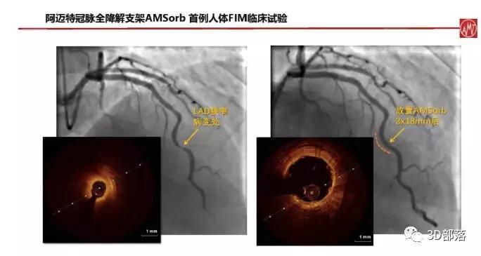 医疗重磅：阿迈特3D打印全降解冠脉药物洗脱支架系统，完成首例临床试验入组