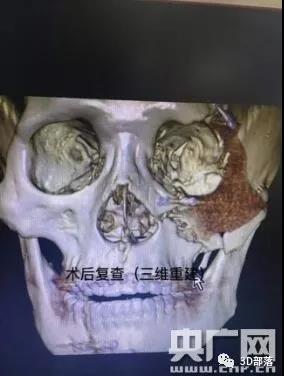 安徽首例！3D打印材料拯救毁容面庞