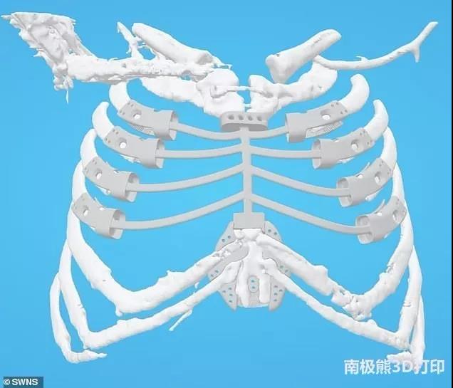 英国52岁女性胸骨塌陷，医生为其安装3D打印钛合金胸骨