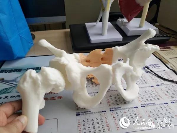 黑龙江省医院3D打印技术让85岁老人告别轮椅站起来