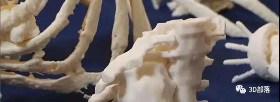 西班牙Donostia大学医院：3D打印可改善胸壁肿瘤治疗效果
