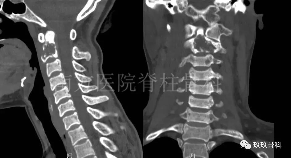 南方医院脊柱骨科完成国内首例单一前路经口腔枢椎肿瘤切除+3D打印人工椎体置换术