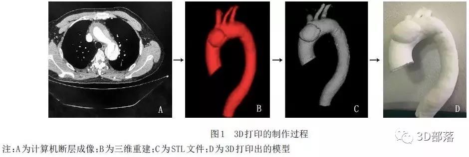 3D打印技术在心血管疾病中的应用和进展