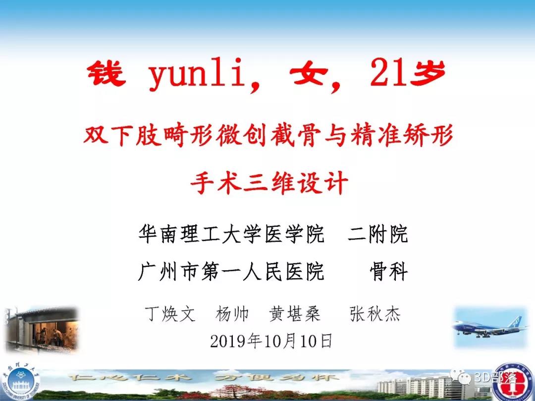 广州市第一人民医院：双下肢畸形微创截骨与精准矫形手术三维设计