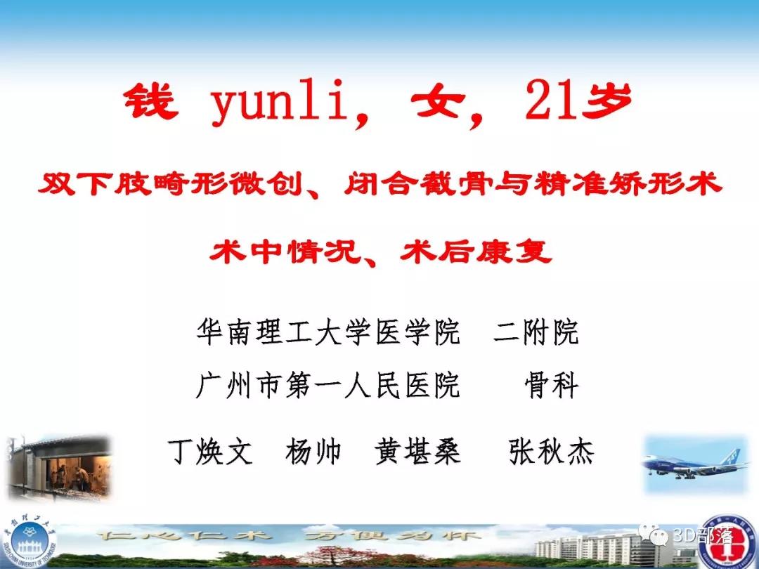 （续）广州市第一人民医院：双下肢畸形微创截骨与精准矫形术中情况及术后康复