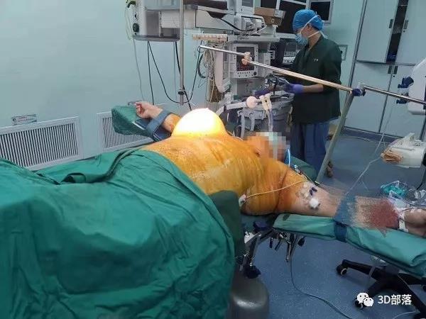男子长10斤肿瘤 专家6小时切除并植入3D打印弹性肋骨