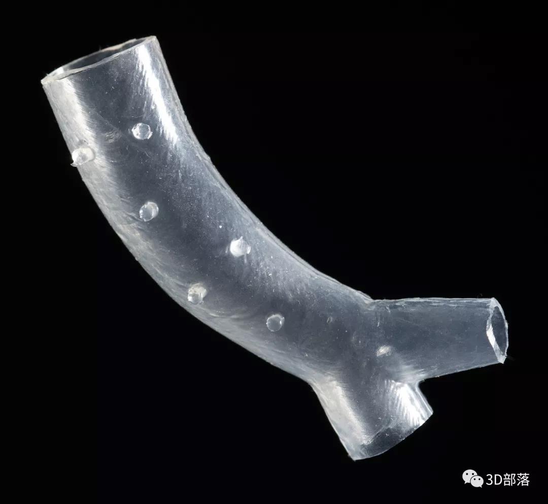 3D打印模具为患者定做专用硅胶气管支架，获得美国FDA批准