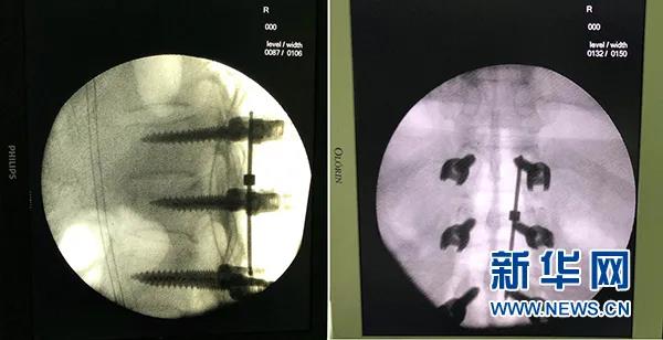宁夏医科大学总医院成功应用3D打印导板技术