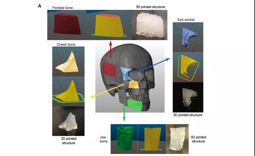 研究人员使用3D打印的生物材料制作面部骨移植术