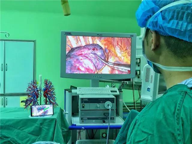 贵州省首例3D打印模型下的精准肺段切除手术在省医完成