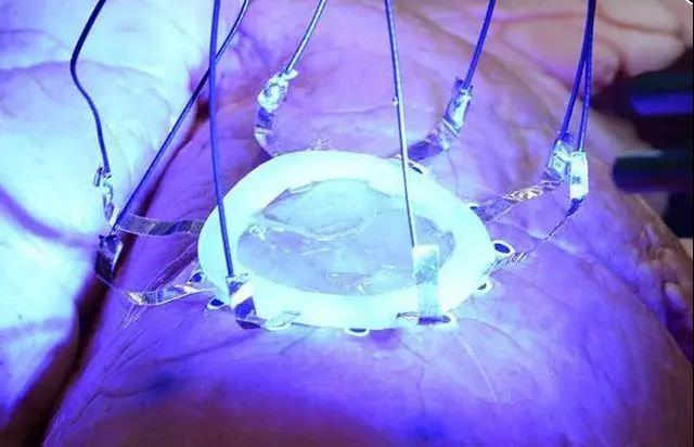 研究员成功在扩张的肺部上3D打印一个柔性医疗传感器