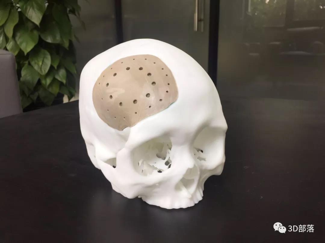 【特别活动】PEEK模型免费打活动