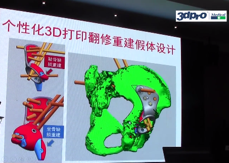 【精彩回顾】郝永强教授《从临床需求的角度看3D打印技术促推个性化医疗的发展》