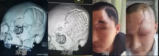 穆苍山主任PEEK颅骨修复整形案例分享：见证材料与技术的至臻化境