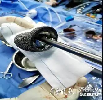 临沂市中医医院应用3D打印技术完成肿瘤关节翻修术