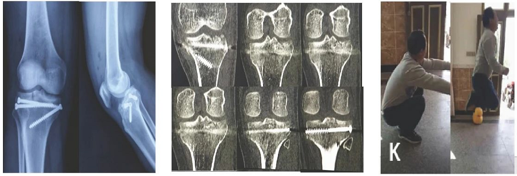 《3D打印骨科—基础与临床案例》征集案例及编者通知