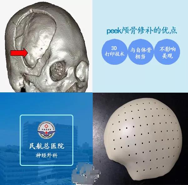 颅骨修补PEEK材料与钛网材料的比较