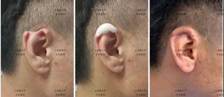 河南省首例3D打印辅助的半耳廓再造在郑大一附院圆满完成