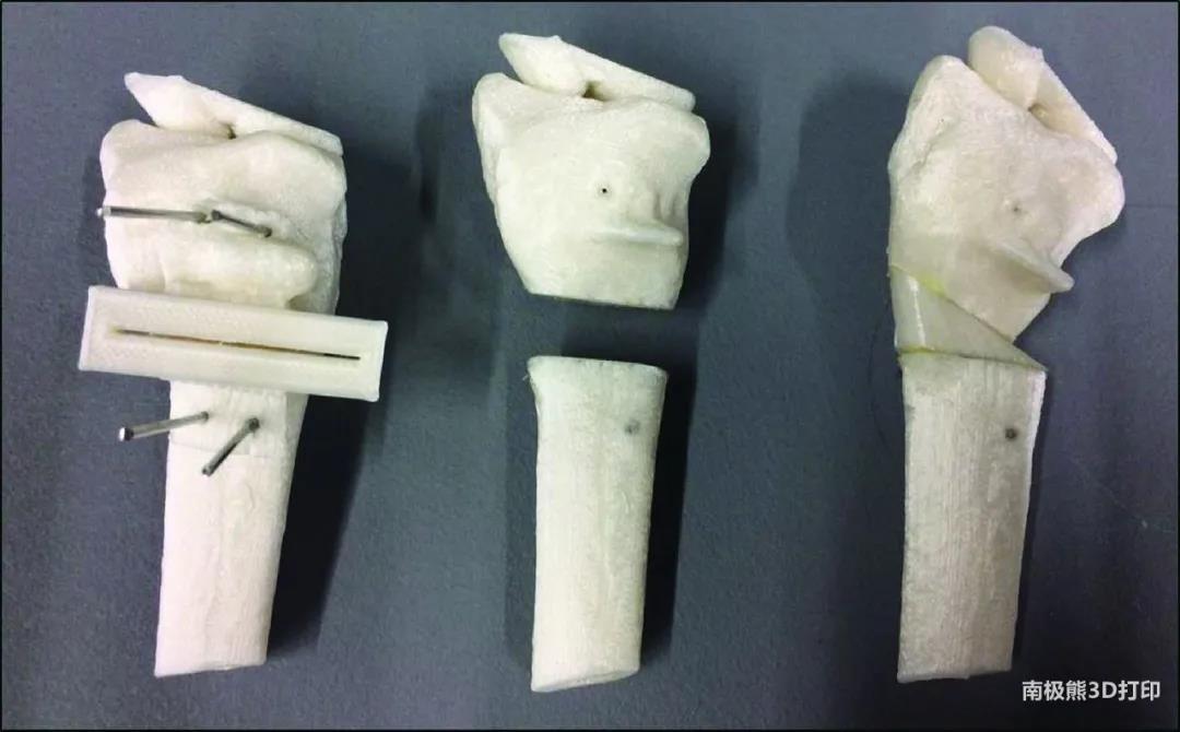 国家药监局:3D打印截骨导板、牙科3D打印金属材料等列入免于临床试验医疗器械目录