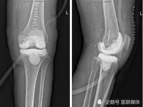 关节置换术后不幸感染？医生巧用3D打印，精准治疗解顽疾