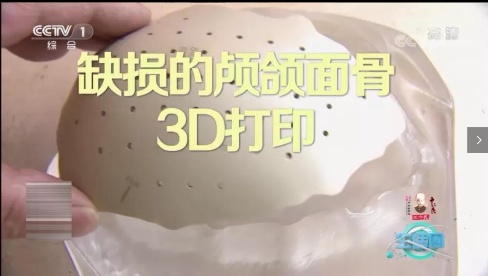 央视综合频道：《医疗新技术：3D打印颅骨》