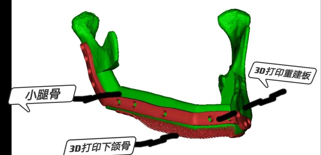 山东大学第二医院妙手“易容”，3D打印骨和小腿骨“组装”变下巴