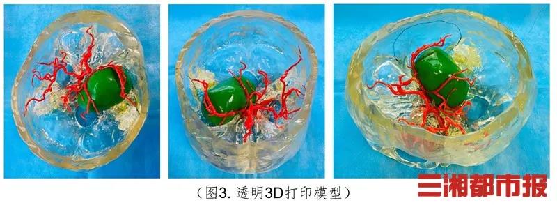 透明3D打印，助力颅底海绵窦区巨大脑瘤切除