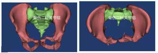 莱州中医完成首例3D打印模拟复位技术联合机器人手术治疗复杂骨盆骨折