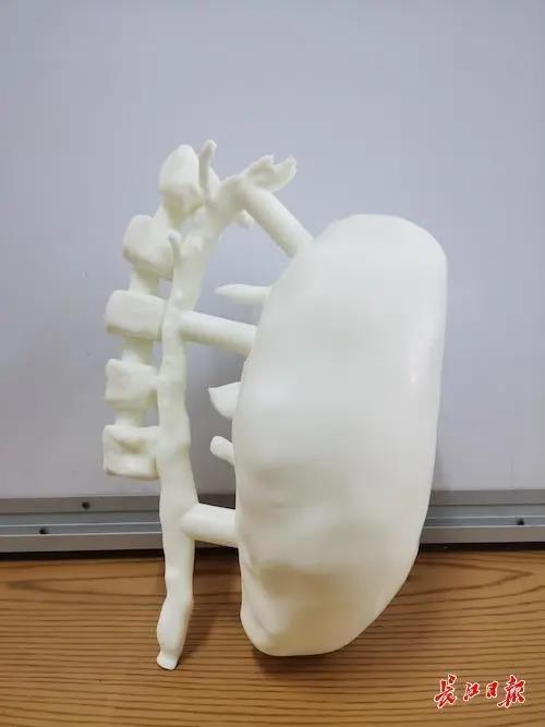 女子背着“篮球”半年，3D打印助医生精准切除