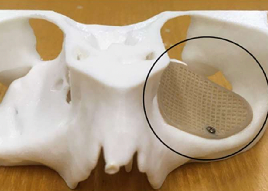 巴塞尔大学：独特的多孔PEEK 3D打印植入物设计用于治疗眼窝骨折