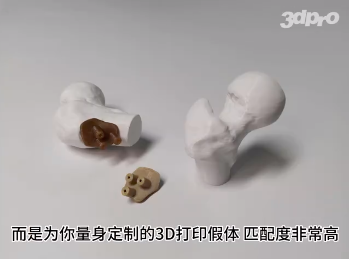 3D打印PEEK材料定制假体的优点
