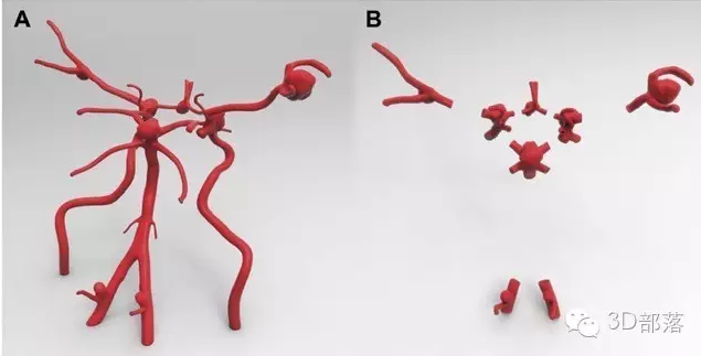 有趣的 3D 打印脑动脉瘤模型