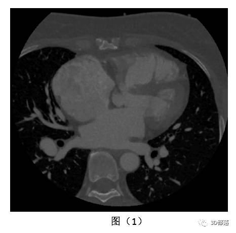 【实战案例】3D打印心房间隔缺损模型助力手术规划