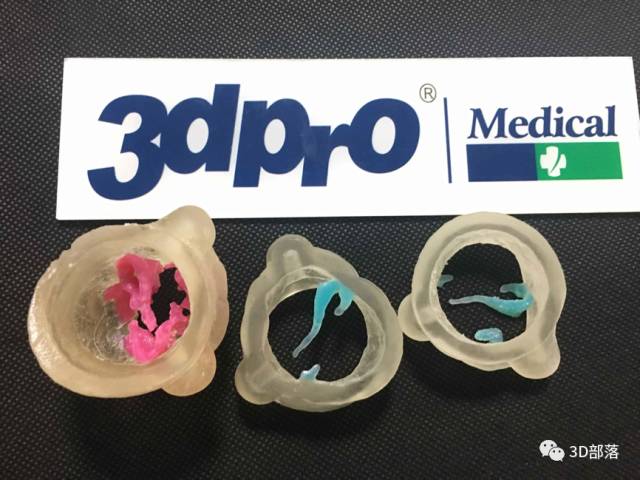 【实战案例】3d打印助力心脏主动脉瓣钙化手术