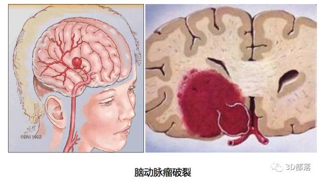 【实战案例】脑血管瘤重建 3D打印助力术前规划