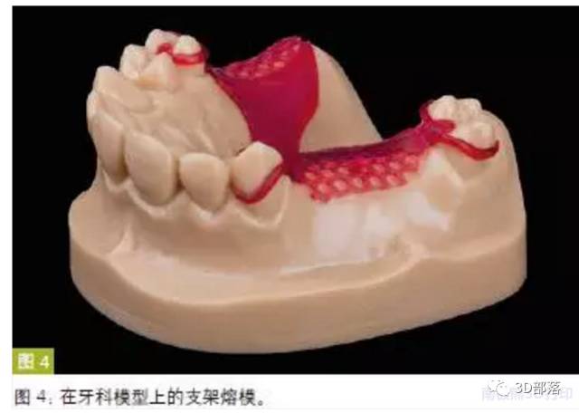 【解析】3D打印在牙科技工领域的应用范围和材料要求