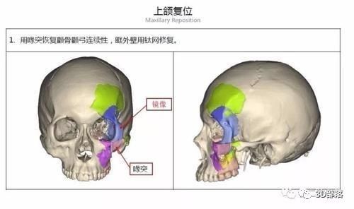 90后富源小伙面部意外粉碎性骨折 3D打印技术“再造”新脸